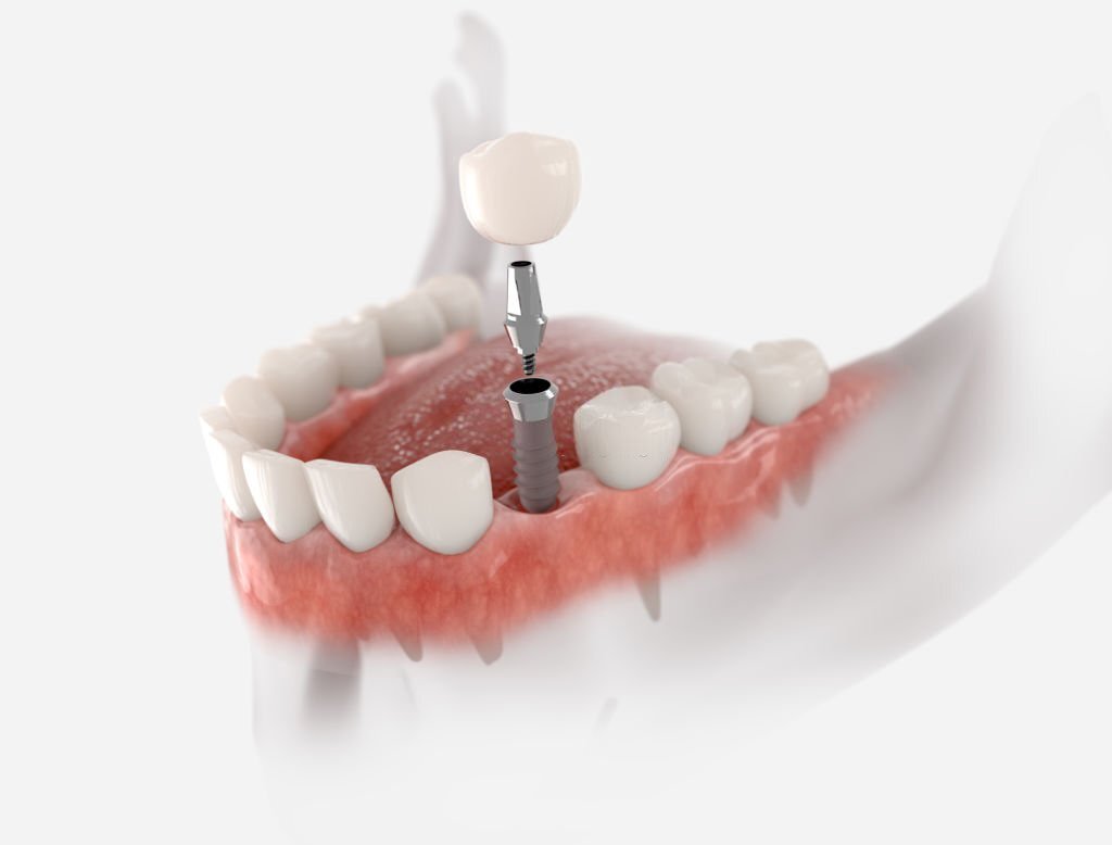 Tandblekning, skalfasader, bettskenor, rotfyllning, rotbehandling, amalgamsanering, blekning, implantat, tandsten, tandläkare, tandblekning, tandblekningsmedel, folk tandvården, tandblekmedel, Implantat, skalfasader, tandvård, tandimplantat, tandreglering, tandhygienist, akut tandvård, tandställning vuxen, osynlig tandställning, tandimplantat pris, tandläkare akut, bleka tänderna, tandvårdsförsäkring, boka tandläkartid, bästa tandblekningen, vitare tänder, tand implantat, implantat tand, akuttandvård, folktandvården akut, tandläkare akuttid, försäkringskassan tandvård, bästa tandblekning, vuxen tandställning, tandregleringen, tandställning för vuxna, skalfasad, tandställning som vuxen, pris rotfyllning, Sveavägen tandläkare, Stockholm tandläkare, implantat tänder, tandblekning bästa, missfärgar tänder, missfärgningar tänder, priser på tandimplantat, munhygien, tandhälsa, akuttid tandläkare, akuttandläkare, tandställning pris, genomskinlig tandställning, akut tandvård kvällstid, boka tid tandläkare, tandhygienist pris, tandblekning tandläkare, akut tandläkartid, akut tid tandläkare, 1177 akut tandvård, estetisk tandvård, tandblekningspenna, sista minuten tandläkare, blekning tänder, tandställning vuxen pris, tandläkare priser, tandläkare Odenplan, skalfasader pris, tand akut, boka tandläkare, tandimplantat hela munnen pris, tandvårdsförsäkring, folktandvården, akut tandvärk, tandblekning pris, tandförsäkring folktandvården, osynlig tandställning pris, implantat tand pris,